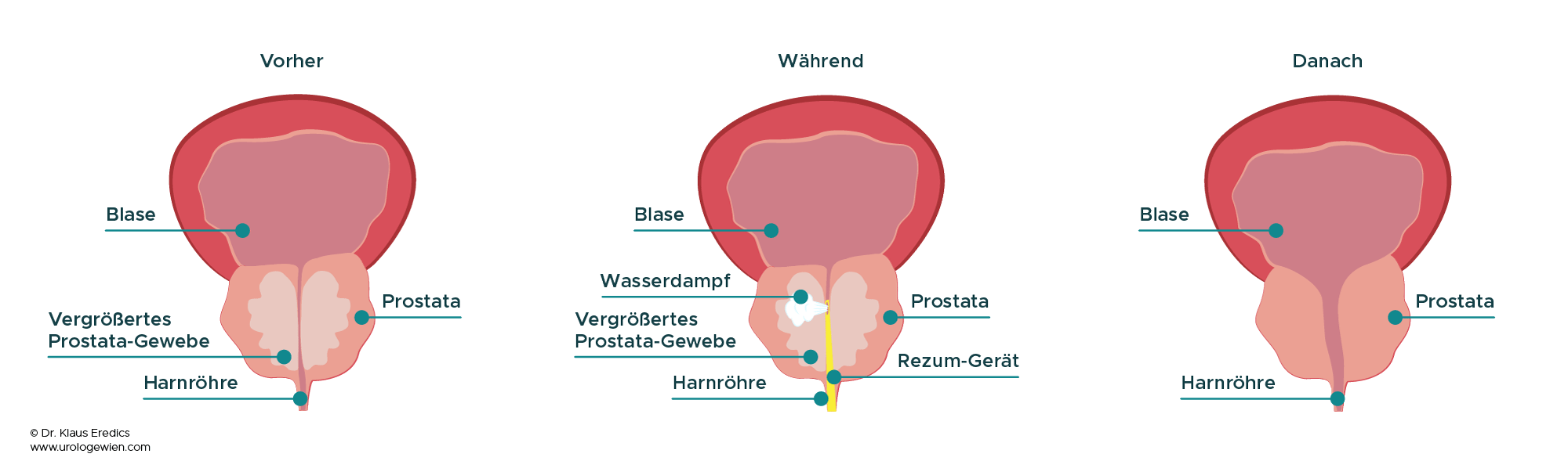 Rezum Prostatavergrößerung