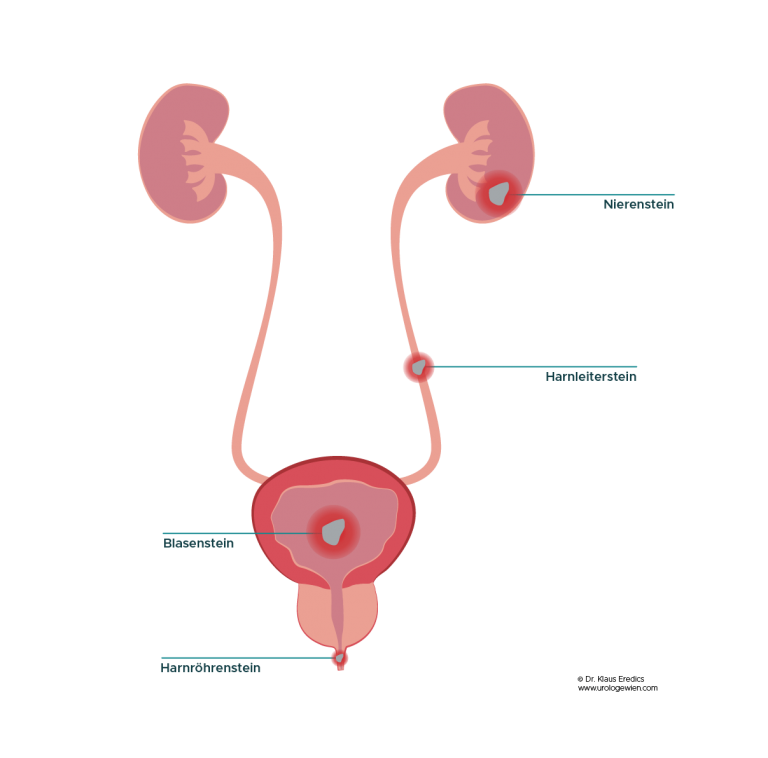 urologische steine