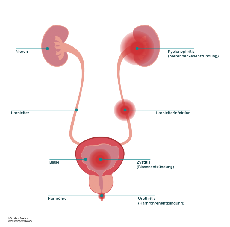 harnwegsentzündungen brennen beim urinieren