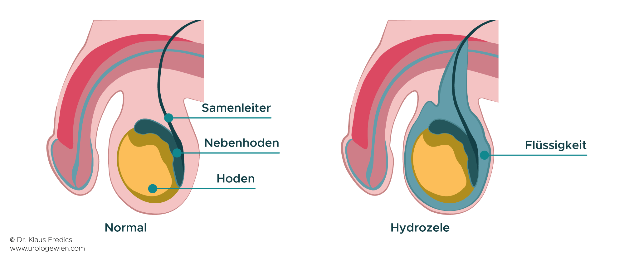 hodenschmerzen hydrozele