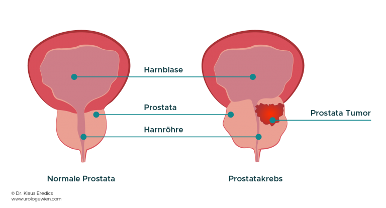 Prostata Krebs