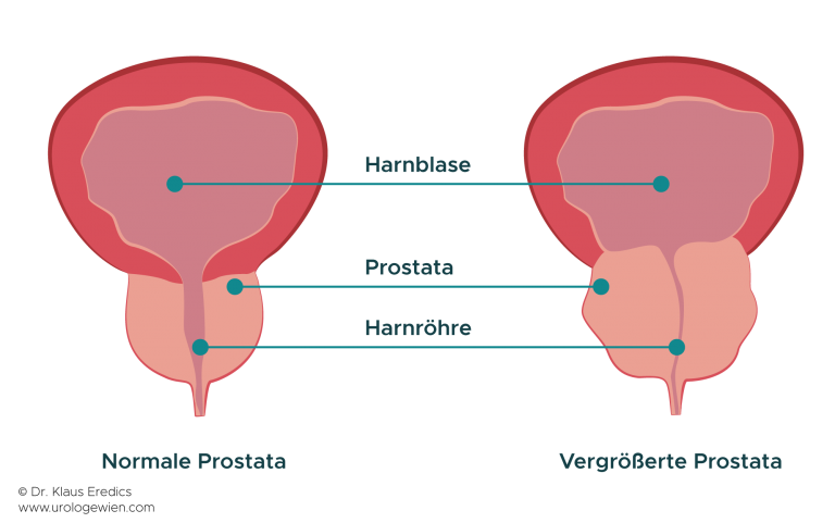 Prostata Vergrößerung
