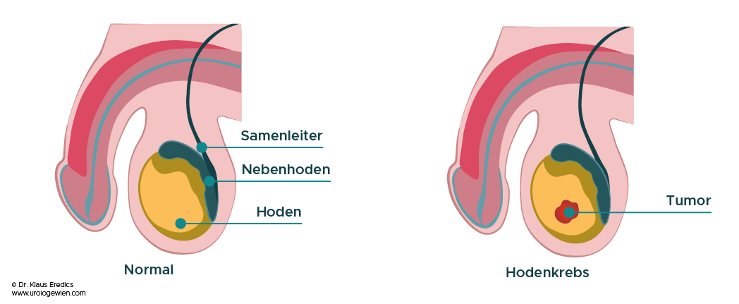 Hodenkrebs