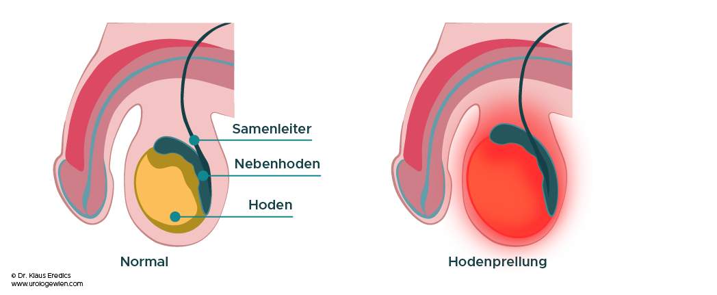 Hodenprellung