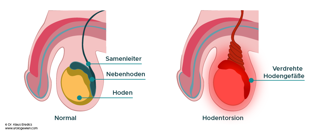 Hodentorsion