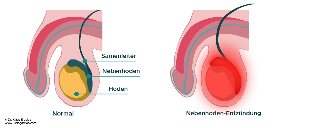 Nebenhodenentzündung