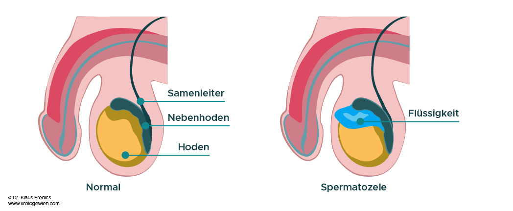 Spermatozele